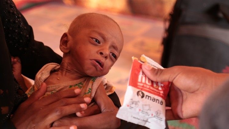 Malnutrizione di un bambino nello Yemen